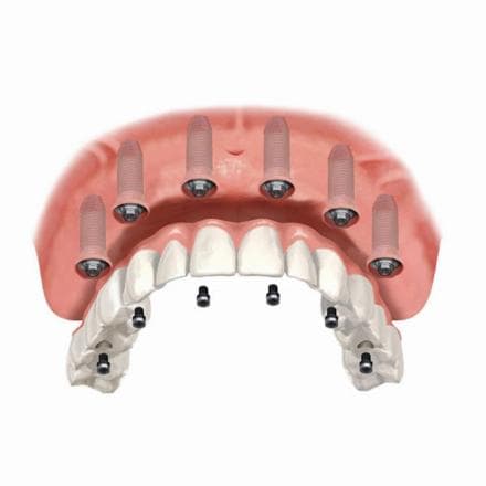 All on 6 dental implants (acrylic teeth)