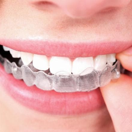 Invisalign braces