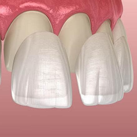 Porcelain veneers