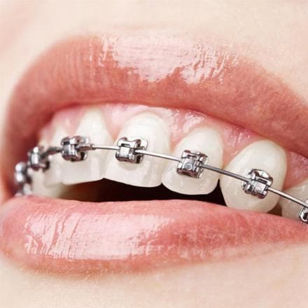 Damon metal braces
